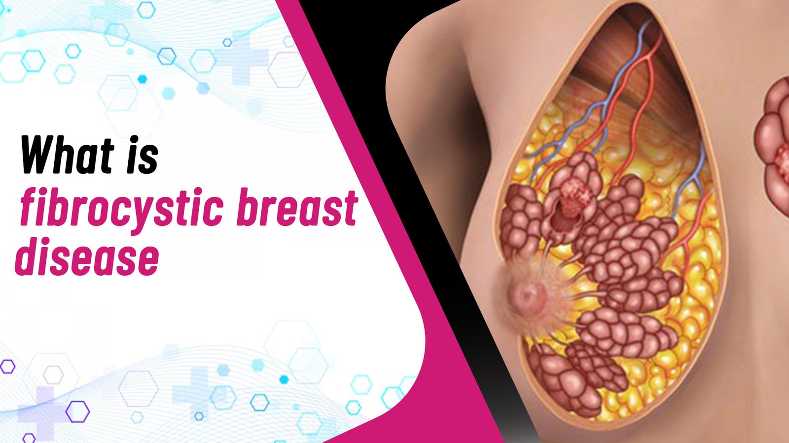 What is Fibrocystic Breast Disease?