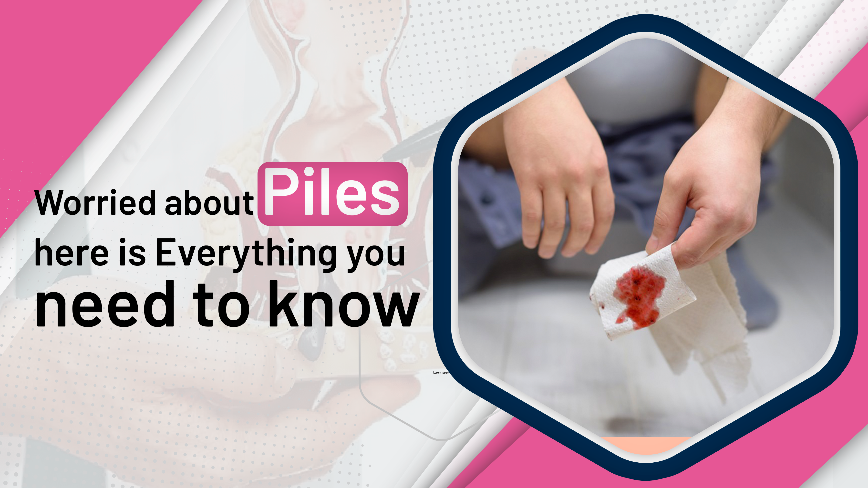 Worried about Piles here is Everything you need to know