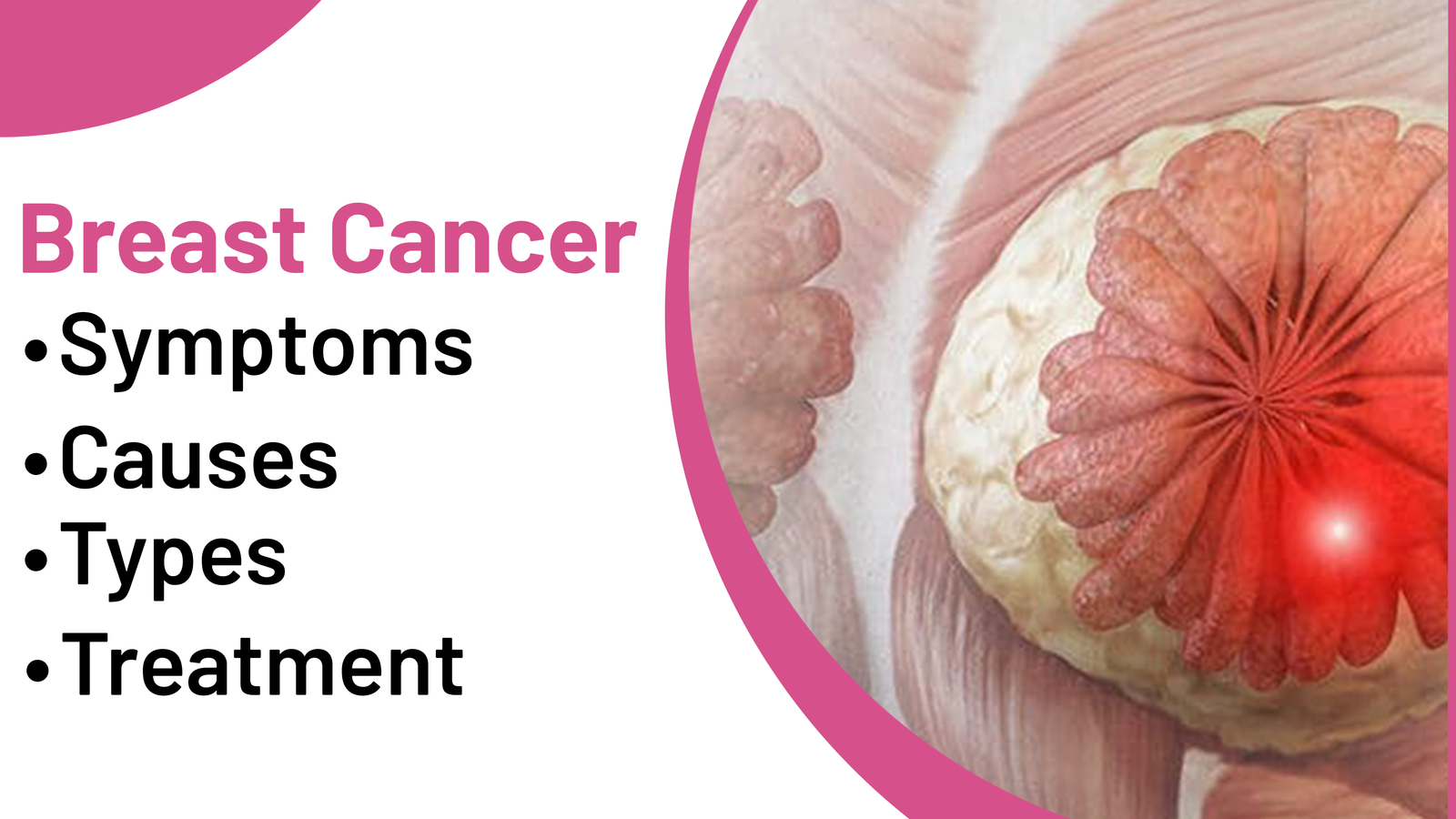 Breast Cancer: Symptoms, Types, Causes & Treatment
