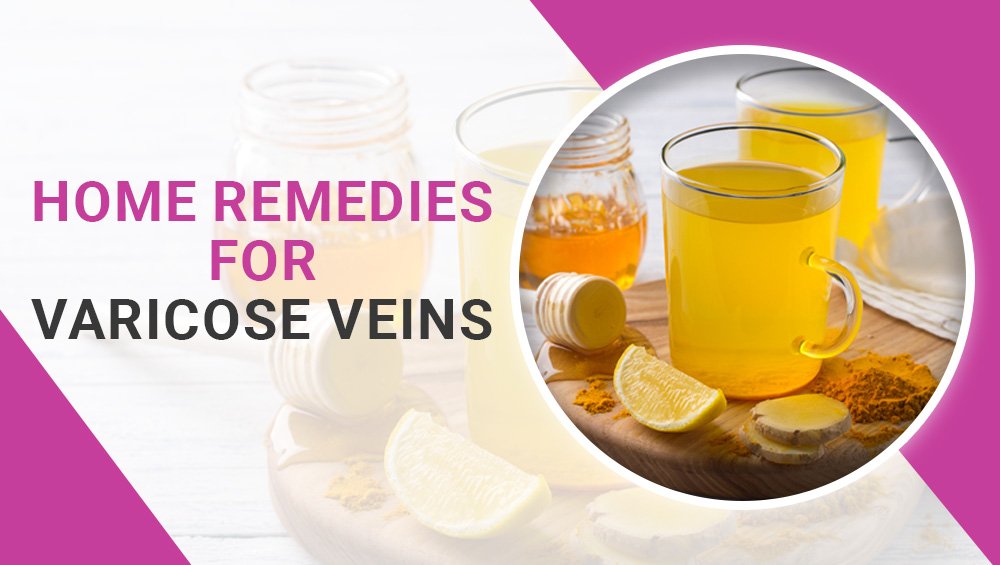 Home Remedies for Varicose Veins - Do they work?